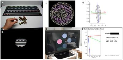Structural and Functional Characteristics of Color Vision Changes in Choroideremia
